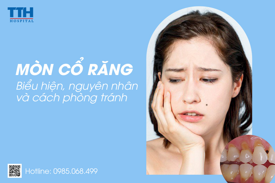 Mòn cổ răng - Biểu hiện, nguyên nhân và cách phòng tránh